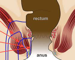  Proctology as Piles(laser )